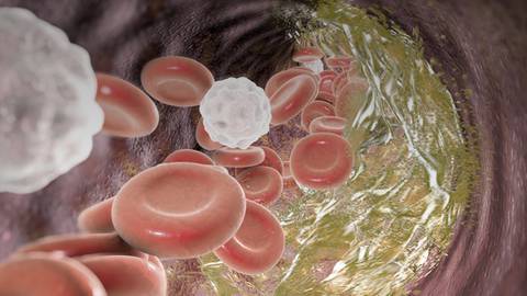 Examining LDL Cholesterol and Our Growing Therapy Options in Primary Prevention