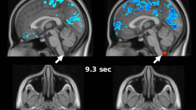 Evidence of Sleep-Dependent Brain Activity in Clearing Toxic Proteins & Preventing Alzheimer’s Disease