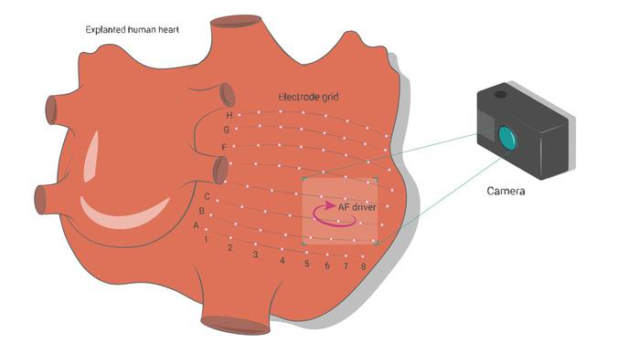 Machine Learning Helps Pinpoint Sources of Most Common Cardiac Arrhythmia