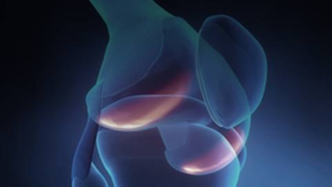 Findings Do Not Support Steroid Injections for Knee Osteoarthritis