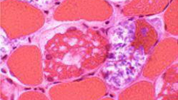 A New Treatment for Rare Muscular Disease