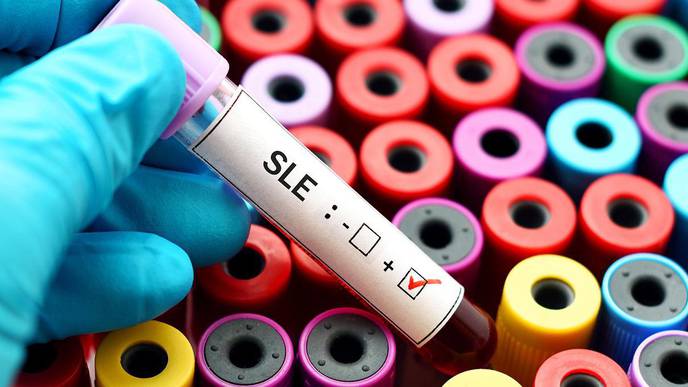 Study Pins Down Number of Americans with Most Common Form of Lupus