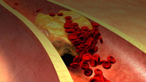Embracing the New Era in Reducing CVD Residual Risk Beyond Statin Therapy