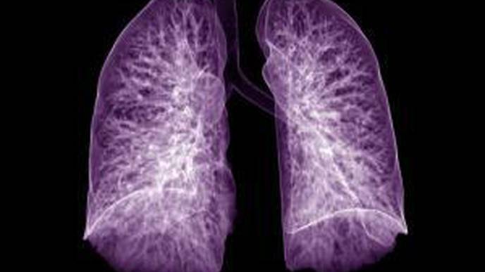 lung-complications-noted-in-half-of-covid-19-surgical-patients