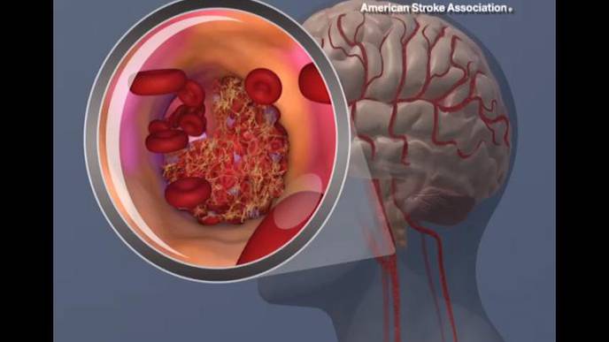 Risk of Second Stroke Can Be Reduced with Prevention Efforts Based on Cause of First Stroke