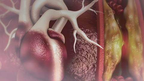 Dialogues from the Dais: CVD Risk Reduction in the Hypertriglyceridemic Patient