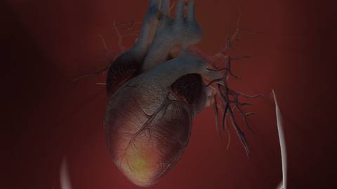 Clinical Implications of Heart Failure Trials Presented at the ACC.20/WCC Virtual Late-Breaker Session