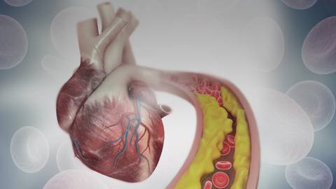 Update on ASCVD Risk Assessment and Management