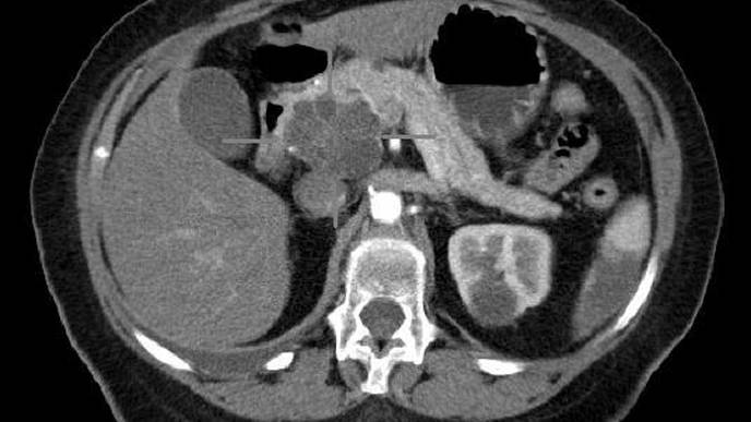 Using Genetically Engineered T Cells to Fight Pancreatic Cancer