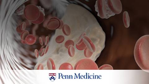 Unclog the Arteries: Treatment Options for Arterial Disease